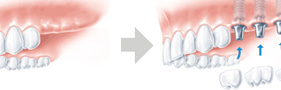 奥歯（上顎）の症例