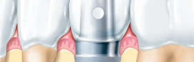 奥歯（下顎）の症例