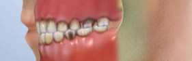 歯周病の場合の治療